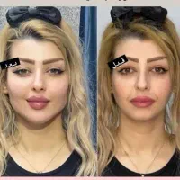 تخفیف ویژه۳روزه ژل فیلر بوتاکس مادلینگ پی آرپی مزو