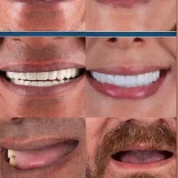 ۱۵درصد تخفیف روی خدمات ایمپلنت به مدت محدود|خدمات آرایشگری و زیبایی|تبریز, |دیوار