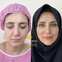 تزریق چربی صورت ماندگاری دائمی روی دست بیکینی باسن|خدمات آرایشگری و زیبایی|تهران, صادقیه|دیوار