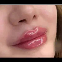 خدمات تخصصی ژل وبوتاکس و پی ارپی ولاغری ورفع غبغب