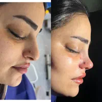 عمل زیبایی بینی با بهترین متد