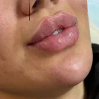 تخفیف۱۰روزه فیلرژل لب گونه