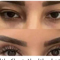 بلفارو ،دایرکت ابرو، ساکشن غبغب