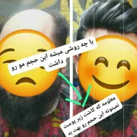 پروتز مو|آرایشی، بهداشتی، درمانی|اهواز, اهواز|دیوار