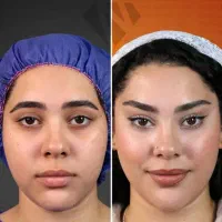 بلفاروپلاستی لیفت صورت بوکال فت تزریق چربی|خدمات آرایشگری و زیبایی|کرمانشاه, |دیوار