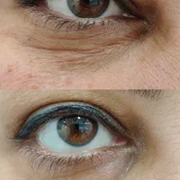 لیزر هایفو ژل بوتاکس ریمو تتو|خدمات آرایشگری و زیبایی|بوشهر, |دیوار