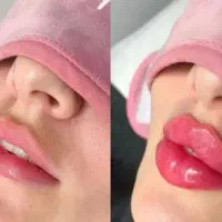 تزریق حرفه ای ژل و بوتاکس ب روش ام دی کد