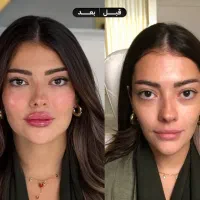 جشنواره ژل لب گونه چونه زاویه فک فیلرزیرچشم بوتاکس