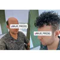 ترمیم مو(پروتز مو)ولوازم جانبی