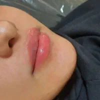 جشنواره ژل و بوتاکس و مزوتراپی لک وجوانسازی بانوان|خدمات آرایشگری و زیبایی|اصفهان, عسگریه|دیوار