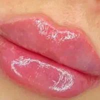 فیلر وبوتاکس فقط هزینه مواد