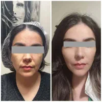 جشنواره تخفیف تزریق ژل و بوتاکس