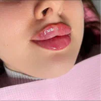 تزریق ژل وبوتاکس