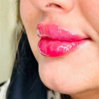 کیلینیک زیبایی دکتر لیپ بوتاکس فیلر زاویه ژل لب|خدمات آرایشگری و زیبایی|تهران, صادقیه|دیوار