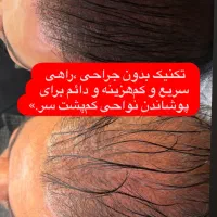 میکرو اسکالپ خداحافظی با کم پشتی موی سر