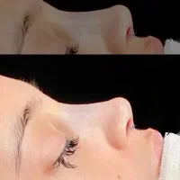 عمل بینی/جراحی بینی/اهواز