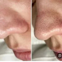 فشیال تخصصی vip پوست به مدت 3 روز فقط 170 تومن|خدمات آرایشگری و زیبایی|مشهد, آزادشهر|دیوار