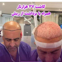 کاشت مو فول تراکم با ضمانت در شیراز|خدمات آرایشگری و زیبایی|لردگان, |دیوار