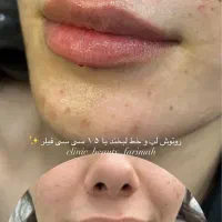 آف فیلر و بوتاکس فقطط۵۸۰|خدمات آرایشگری و زیبایی|ایذه, |دیوار