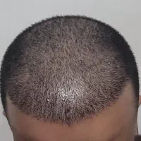 کاشت مو/کاشتمو/کاشت ابرو/کاشت ریش یک مرحله|خدمات آرایشگری و زیبایی|نجف‌آباد, باغ ملی|دیوار