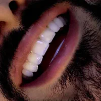 دندانپزشکی شاین . ترمیم دندان . کامپوزیت