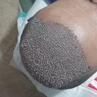 کاشت مو و کاشت ابرو، میکروگرافت|خدمات آرایشگری و زیبایی|کرمانشاه, |دیوار