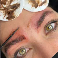 تتو بدن،فیبروز،ریموو