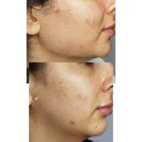 زاویه فک به سبک طبیعی|خدمات آرایشگری و زیبایی|رشت, منظریه|دیوار