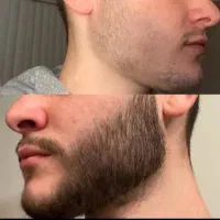 ماینوکسیدیل می‌زنی و از عوارضش بی خبری