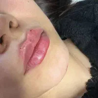 ژل و بوتاکس|خدمات آرایشگری و زیبایی|مشهد, طلاب|دیوار
