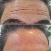 تخفیف ویژه بوتاکس، ژل، پی آر پی، رفع کک و مک|خدمات آرایشگری و زیبایی|بوکان, |دیوار