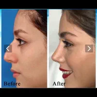 جراحی زیبایی بینی با بروز ترین متد (پیزو سرجری)