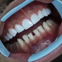 دندان پزشکی اقساطی.عصب کشی ،کامپوزیت ،روکش متحرک