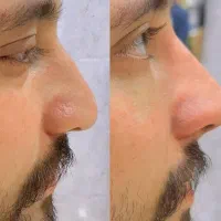 عمل زیبایی بینی