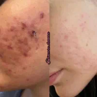 شیدلب.رفع تیرگی.فشیال تخصصی.آموزش.پیراپزشک هستم|خدمات آرایشگری و زیبایی|زاهدان, |دیوار
