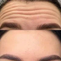 لیزر مو های زائد بوتاکس( تزریق توسط پزشک)