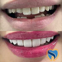 ونیر کامپوزیت ، دندانپزشکی زیبایی ، ایمپلنت