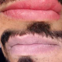 رفع کبودی و بیرنگی لب ها