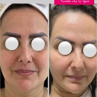 لیزر موهای زائد الکس پلاس (شاتی) بدون ژل/درمان لک|خدمات آرایشگری و زیبایی|رشت, گلسار|دیوار