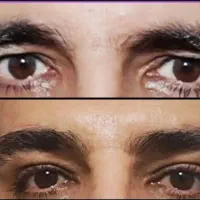 پزشک مسلط به جراحی بلفاروپلاستی|خدمات آرایشگری و زیبایی|تهران, سلسبیل شمالی|دیوار