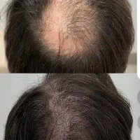 میکرواسکالپ تخصصی با جدیدترین متدvip|خدمات آرایشگری و زیبایی|مشهد, گوهرشاد|دیوار