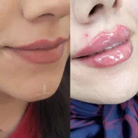 تزریق تخصصی ژل و بوتاکس