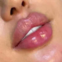 قیمتهای استثنایی کلینیک زیبایی تزریق فیلر ،بوتاکس|خدمات آرایشگری و زیبایی|نسیمشهر, |دیوار