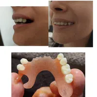 دندان مصنوعی متحرک جایگزین ایمپلنت بصورت آنی|آرایشی، بهداشتی، درمانی|رشت, گلسار|دیوار
