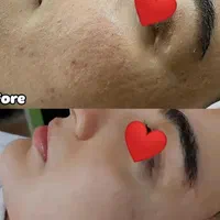 پاکسازی تخصصی پوست صورت|خدمات آرایشگری و زیبایی|اصفهان, فرح آباد|دیوار