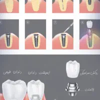 ایمپلنت دیجیتال/تهران و کرج/ویژه مراجعین از قزوین|خدمات آرایشگری و زیبایی|قزوین, |دیوار