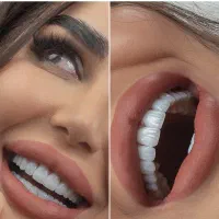 کامپوزیت دندان‌از دم‌اقساط بدون پیش پرداخت