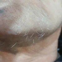 الکترولیز موی سفید وسیاه صورت بانوان فقط