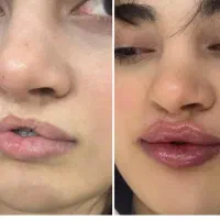 ژل وبوتاکس نورامیس فقط وفقط ۹۹۹|خدمات زیبایی و سلامت|تهران, سجاد|دیوار