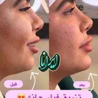 تزریق ژل و بوتاکس تضمینی (کلنیک ایرانا)|خدمات آرایشگری و زیبایی|یاسوج, |دیوار